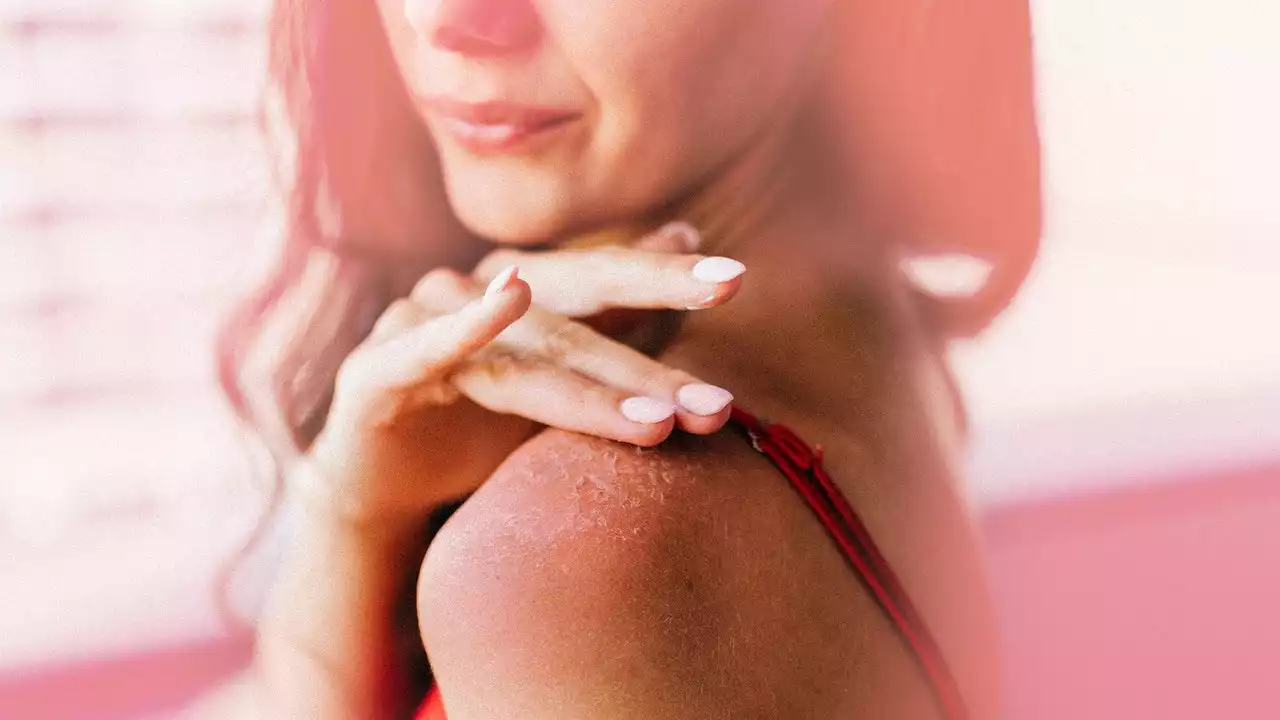 Your Sunburn Is Peeling — Now What?