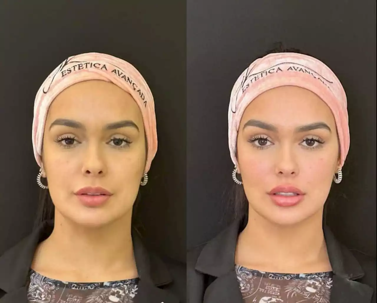 Ex-BBB Larissa Santos faz harmonização facial; veja antes e depois