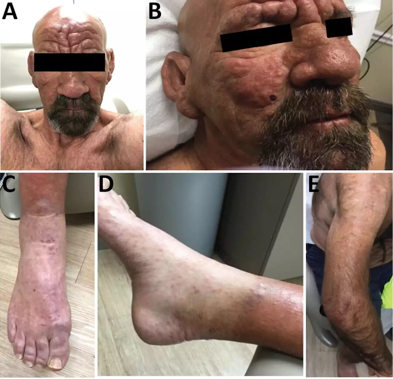 Leprosy May Be Endemic In Central Florida Amid Rise In Cases, CDC Says