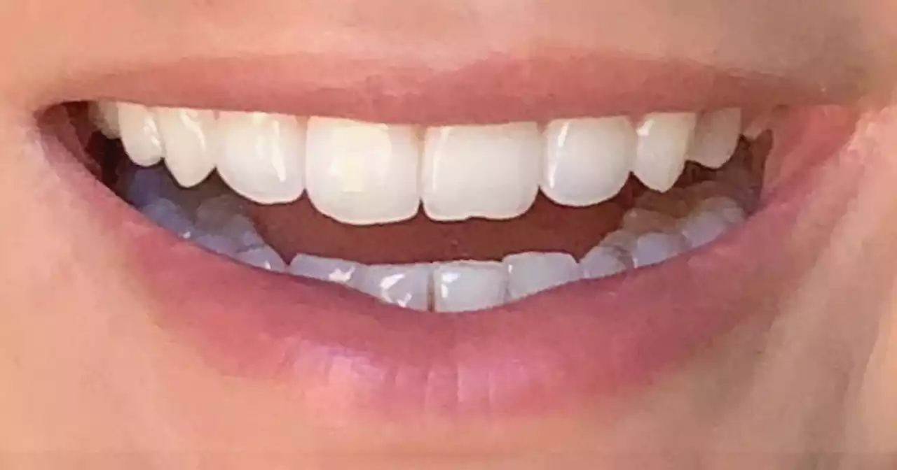 Amazon's 'game changer' £24 teeth whitening solution 'reverses years of stains'