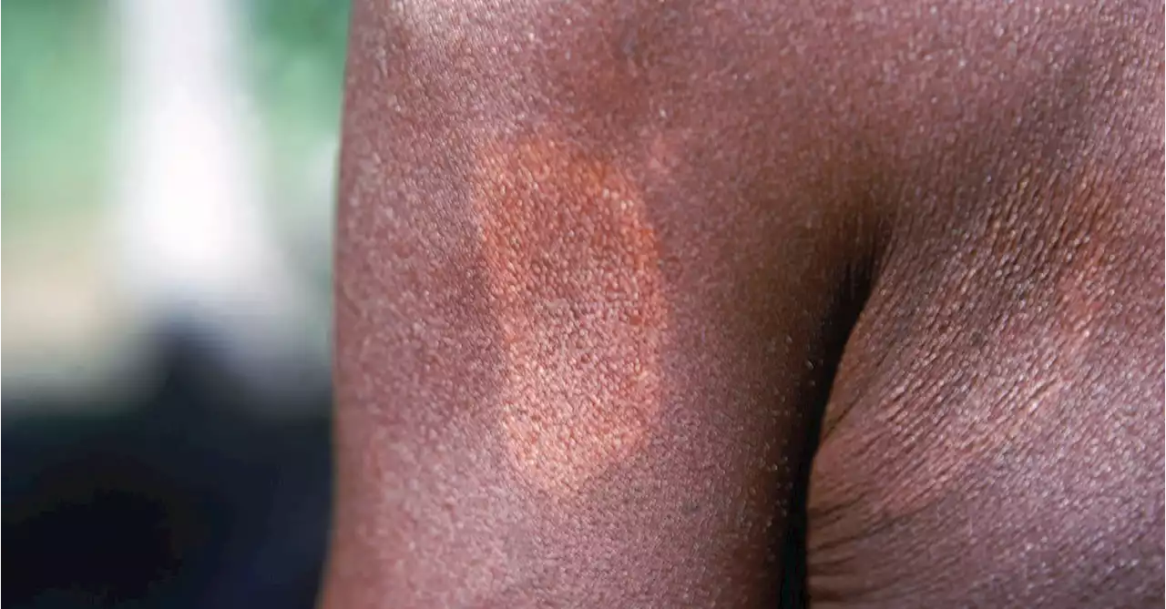 Leprosy Cases in Florida Prompt CDC Warning