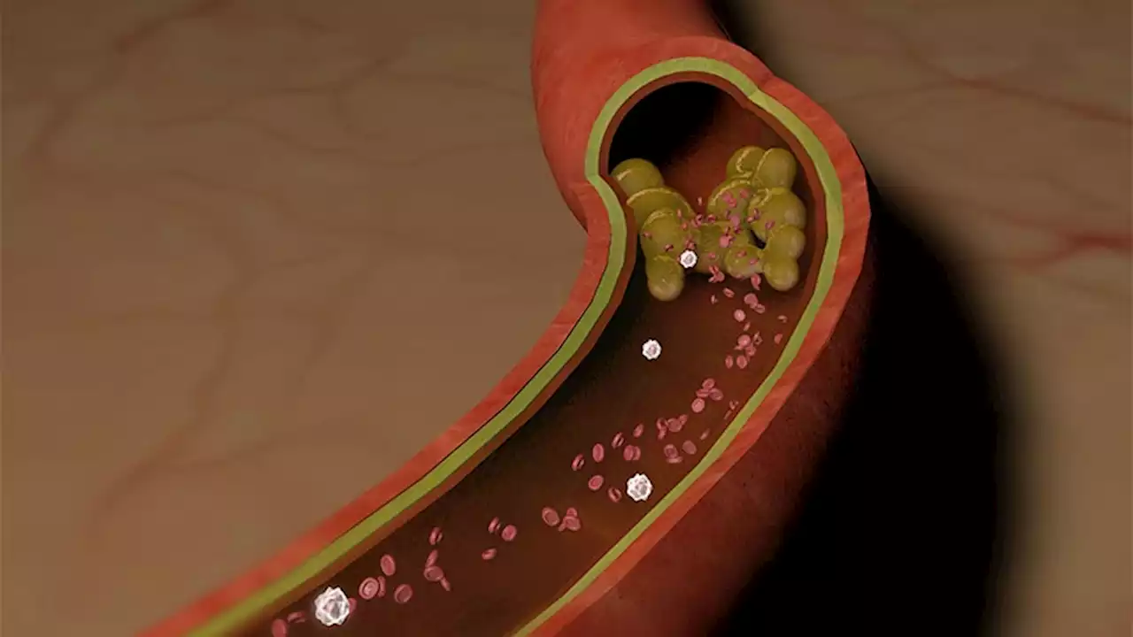 Fast Five Quiz: Non-Statin Lipid-Lowering Therapy