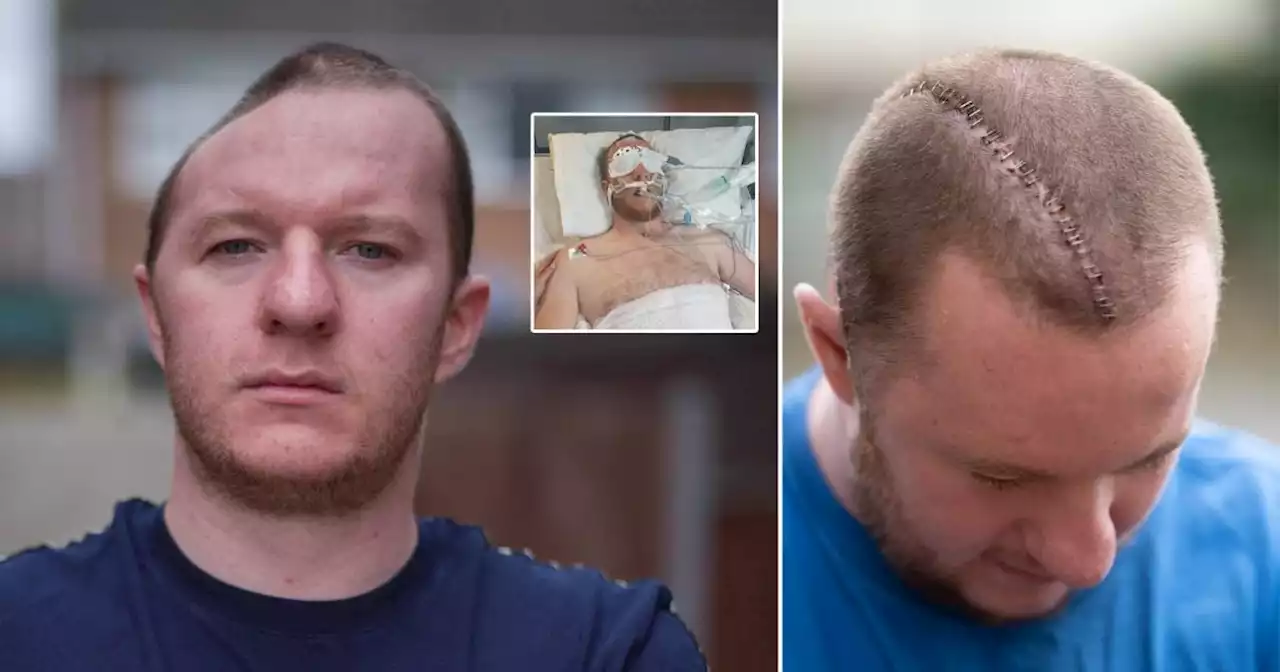 Man has half his skull rebuilt with plastic after just one punch to head