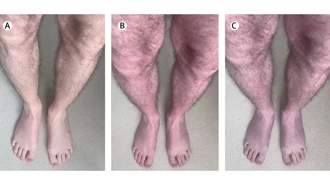 Acrocyanosis, a rare and shocking symptom of long COVID