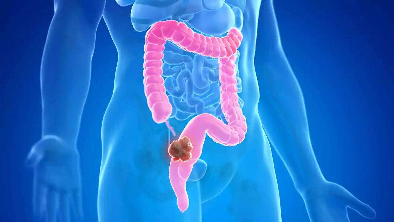 Three things to know about colorectal cancer in people under 50