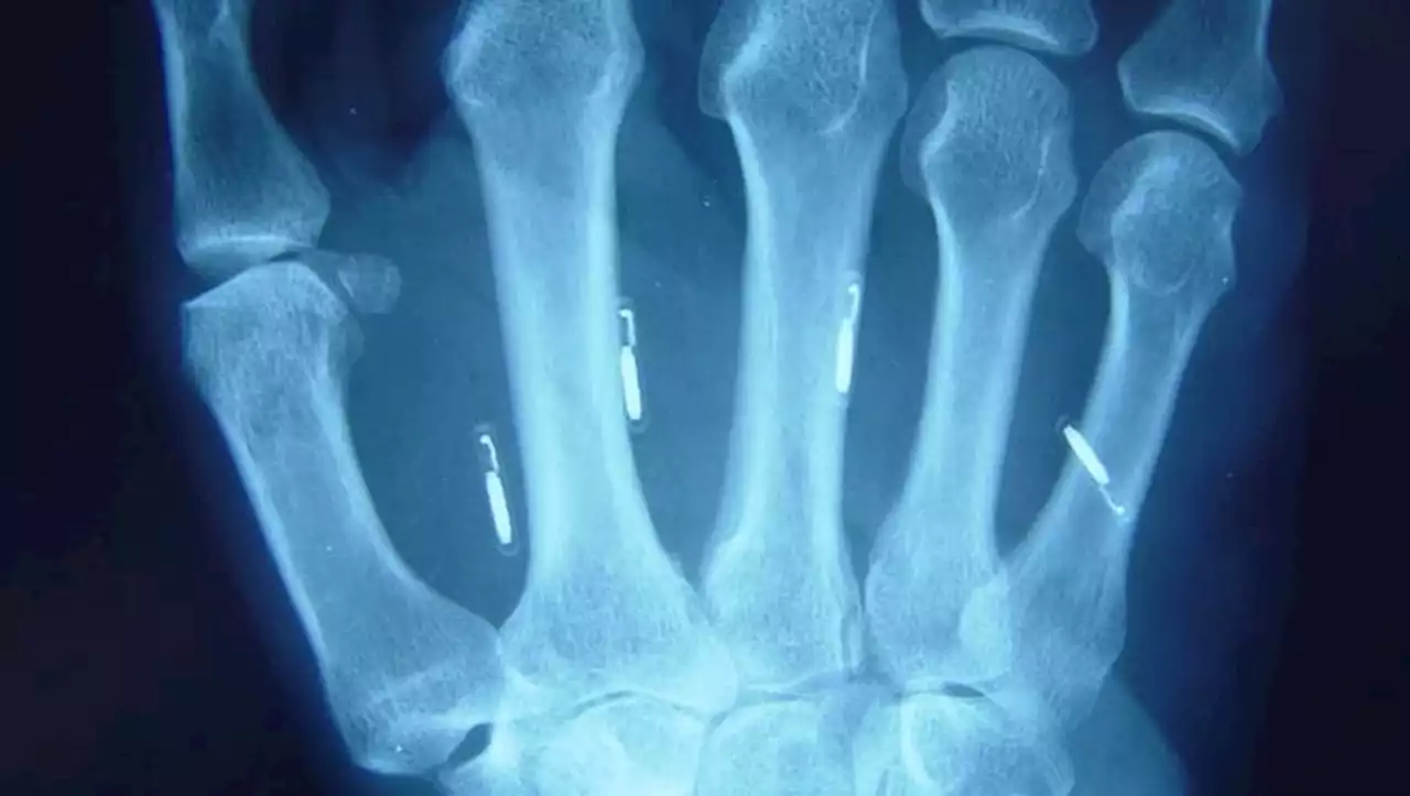Software Engineer Embeds 25 RFID Chips Under Their Skin
