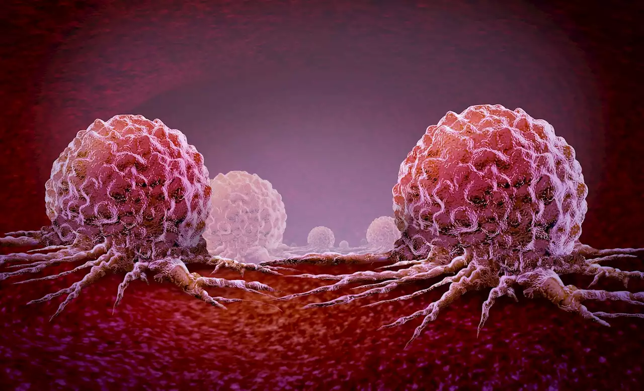 Copy number profiling provides insight as to why prostate cancer may become lethal