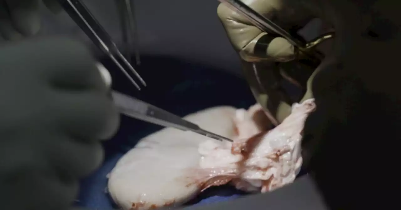 Pig kidney works in a donated body for over a month