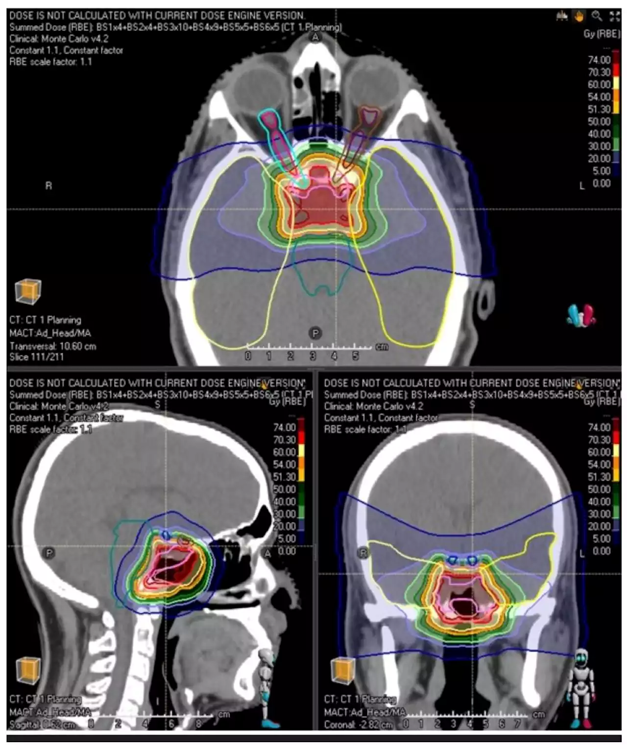 Ion therapy safe and efficacious for the treatment of skull base cancer: Study