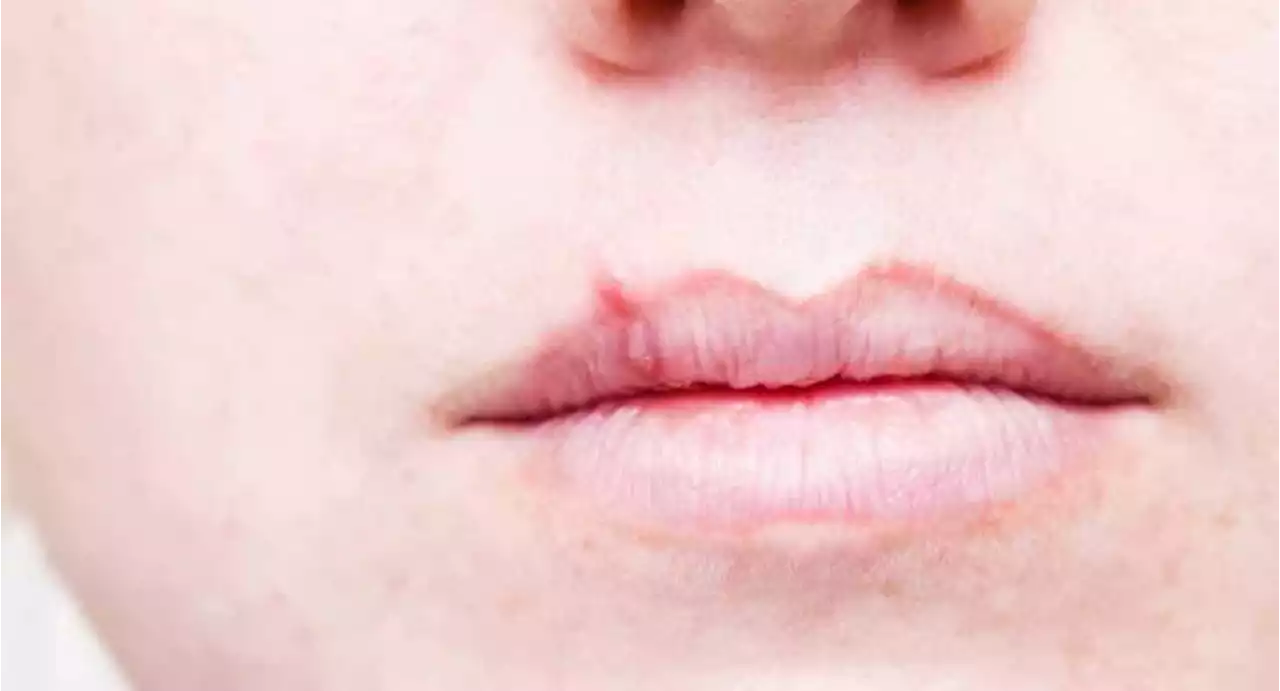 Cold Sore and Fever Blister Remedies