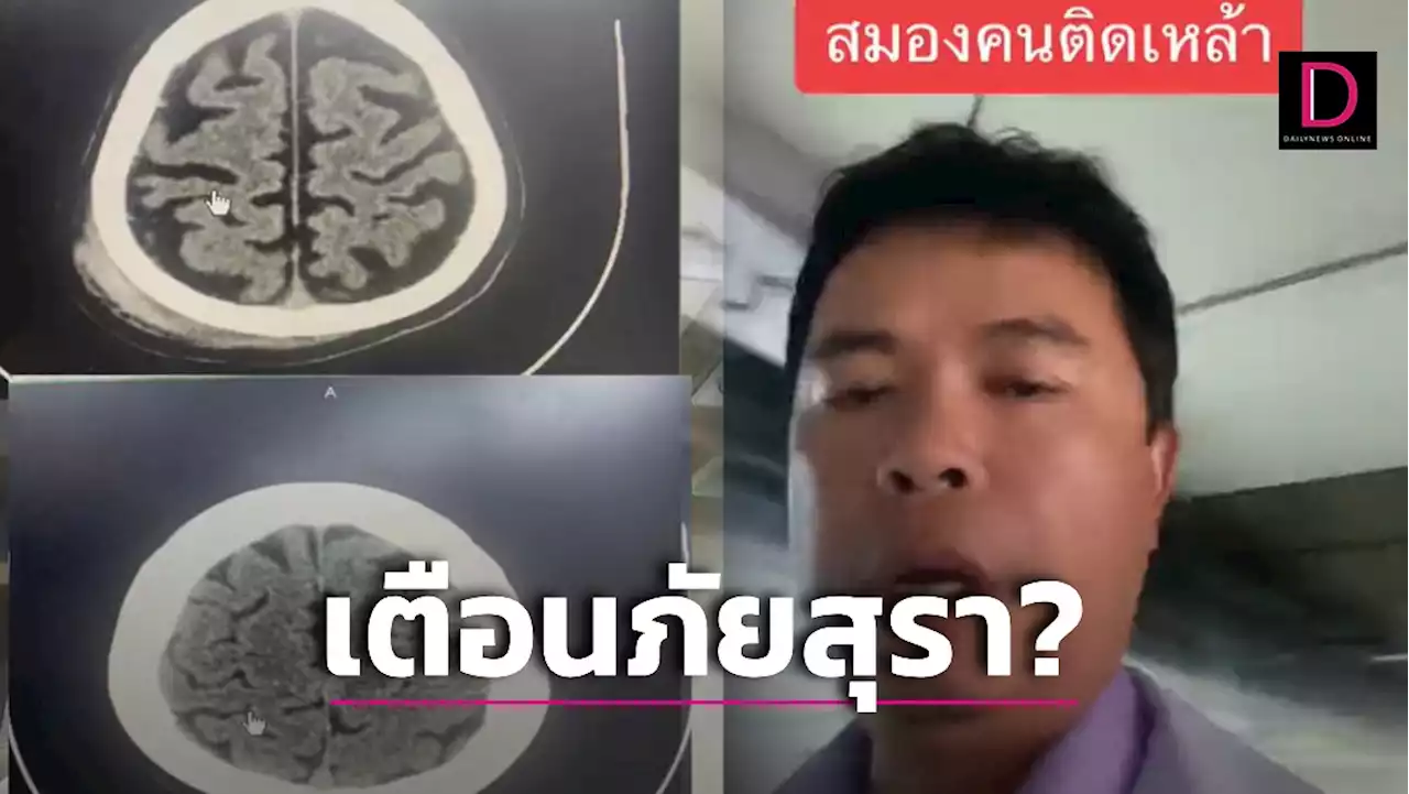 หมอเปิดภาพชัด! คนดื่มสุราจัดเสี่ยง 'สมองฝ่อ' ล้มเลือดออกในสมองง่าย | เดลินิวส์