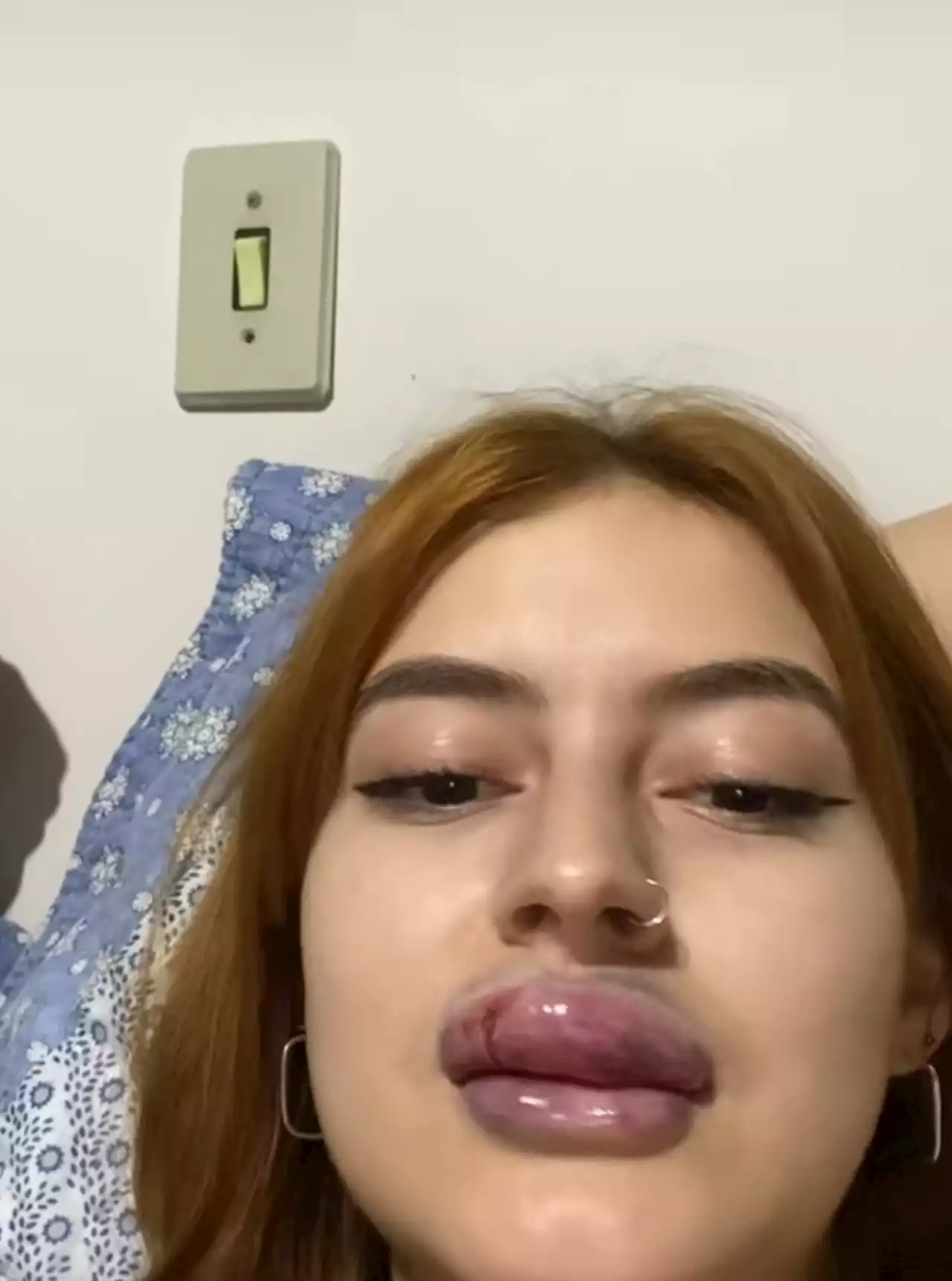 Preenchimento labial: complicações do procedimento viralizam no TikTok; confira os principais riscos