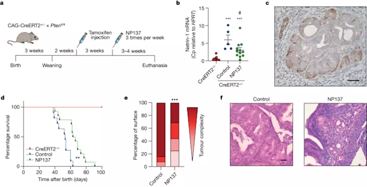 Netrin-1 blockade inhibits tumour growth and EMT features in endometrial cancer - Nature