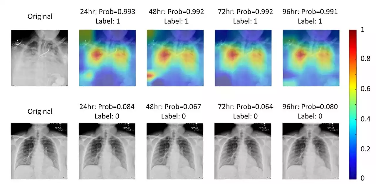 AI to predict critical care for patients with COVID-19