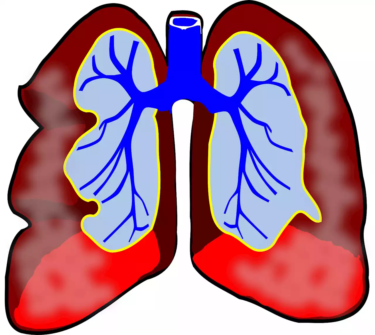 Impacts on lung surgery of the removal of race-correction in lung pulmonary function tests