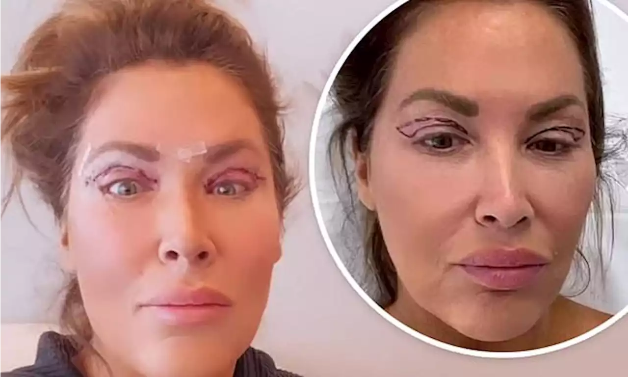 RHOC star Emily Simpson shares videos of her upper eyelid surgery