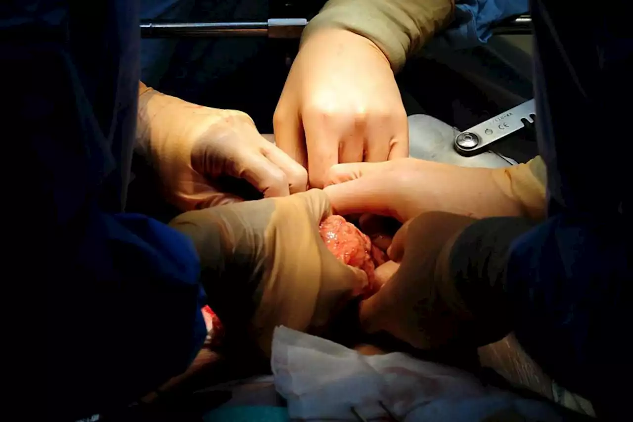 UK’s first womb transplant paves way for dozens more