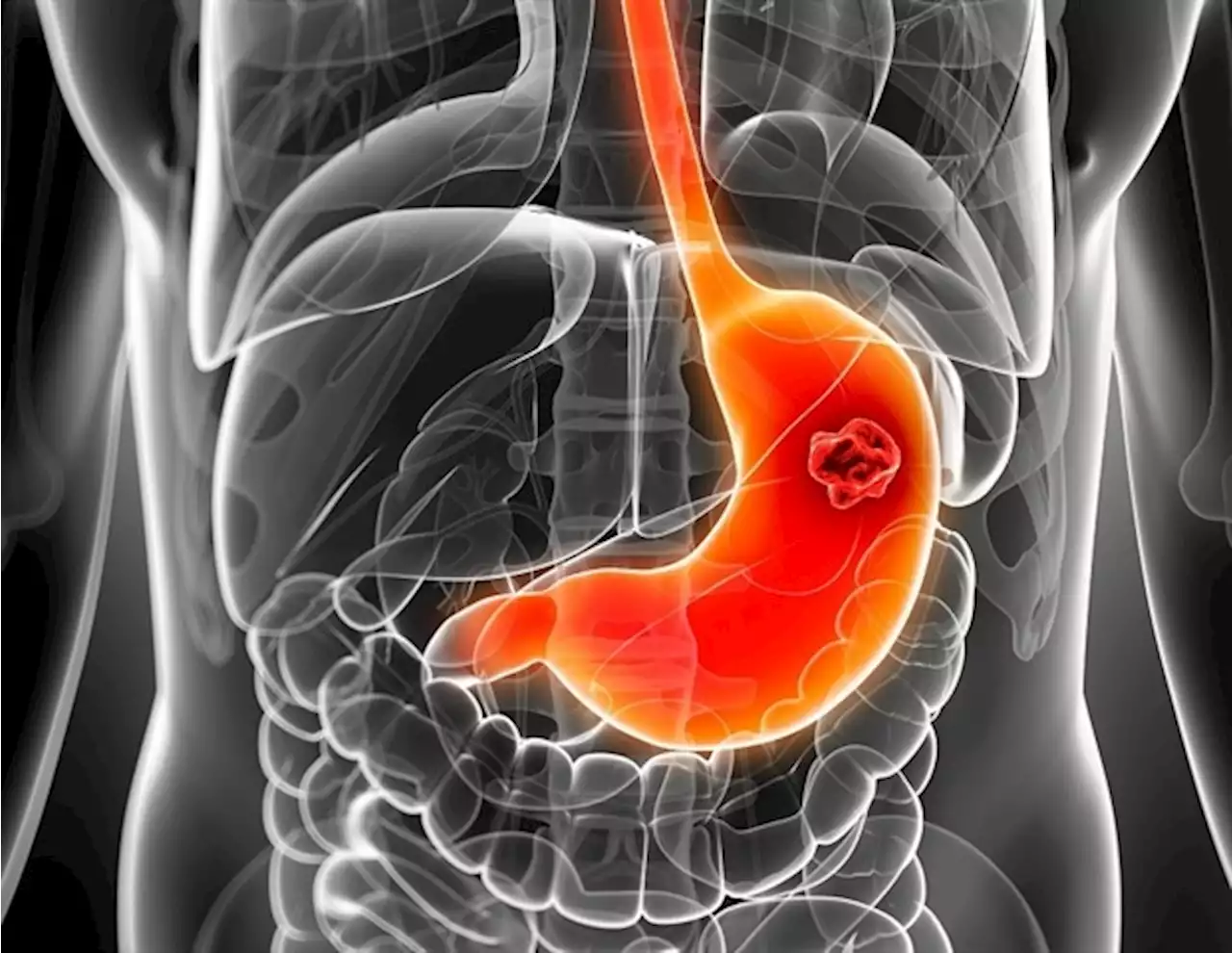 EHR-embedded AI tool can identify patients at risk for esophageal and stomach cancer