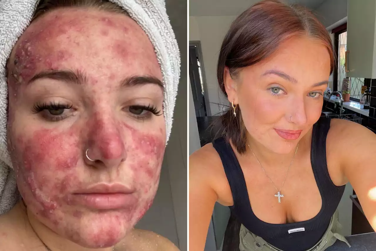 I was called ‘pizza face’ by cruel bullies my whole life — now I’m a beauty influencer