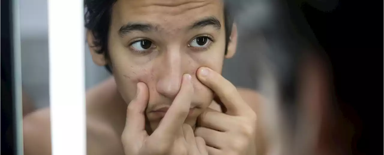 Acne-Causing Bacteria May Actually Be Vital For Healthy Skin, Expert Says