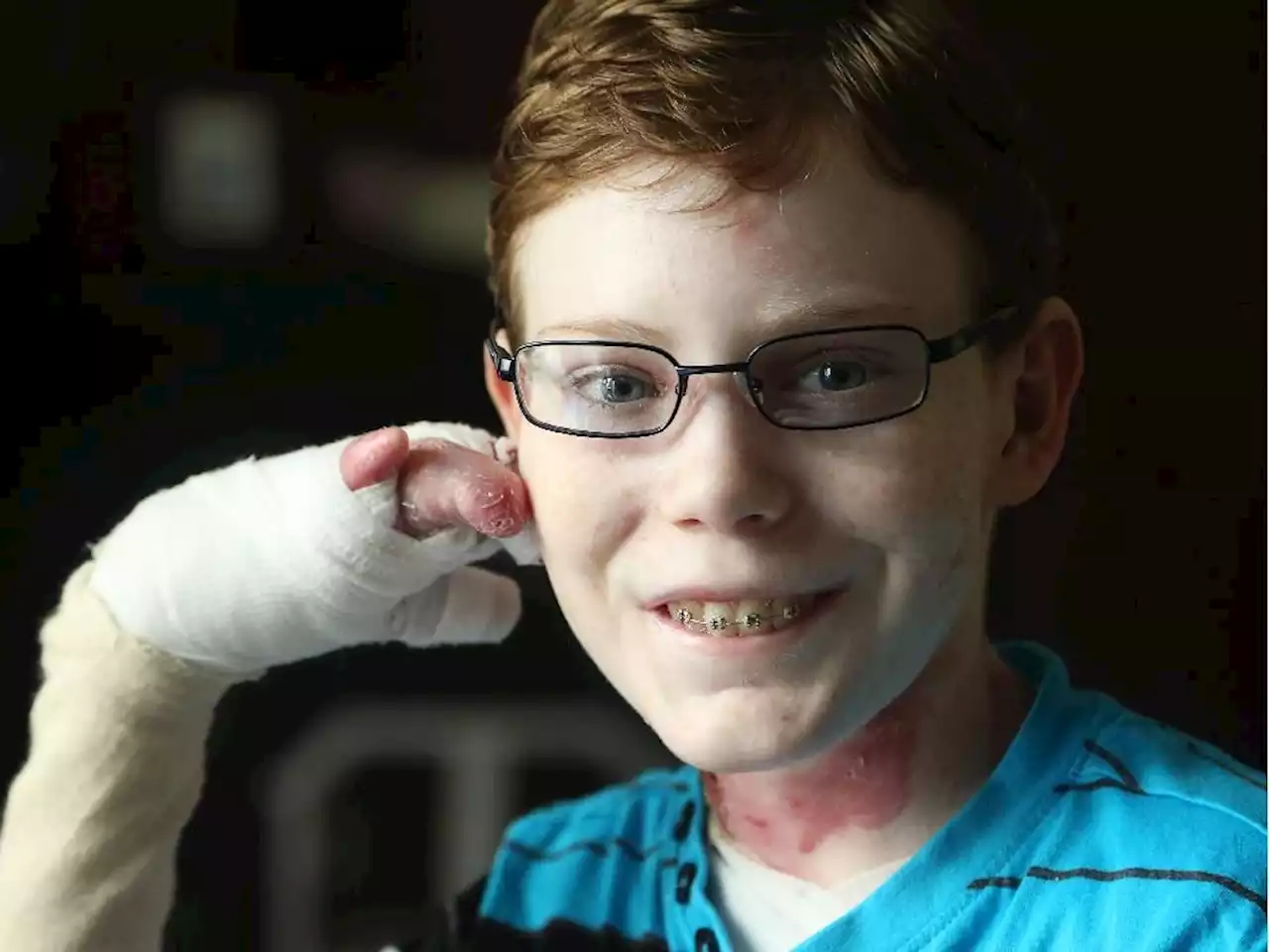 A new treatment for EB emerges five years after Jonathan Pitre's death