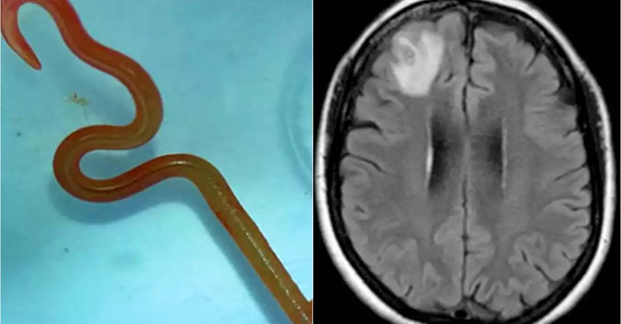 Doctors stunned by 'wriggling' 8cm find in NSW woman's brain