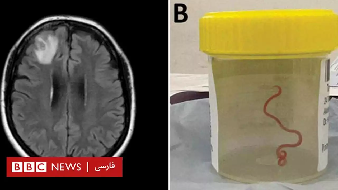 پزشکان استرالیایی کرم زنده هشت ‌سانتی‌متری را در مغز یک بیمار پیدا کردند