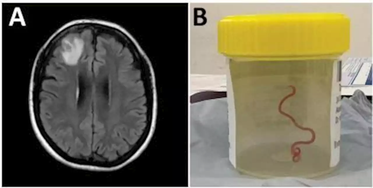 Verme comum em cobras píton é achado no cérebro humano pela 1ª vez, aponta estudo