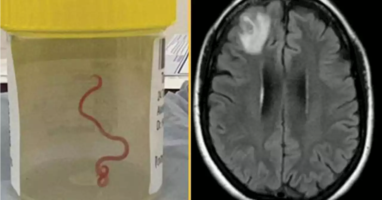 Live worm found in woman’s brain in world first discovery