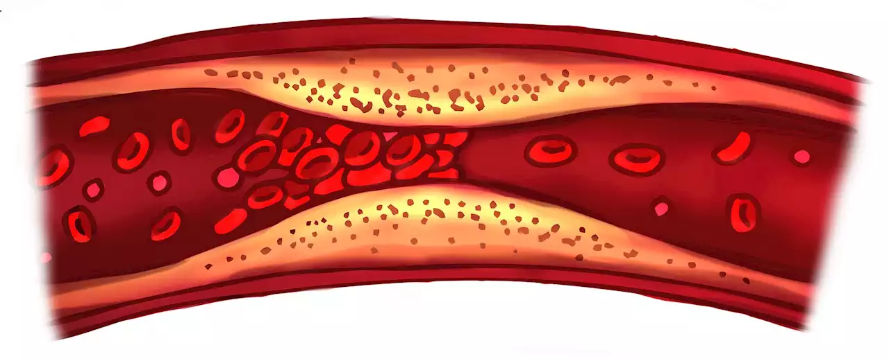 12 months of anticoagulation found to improve outcomes in cancer patients with minor blood clots