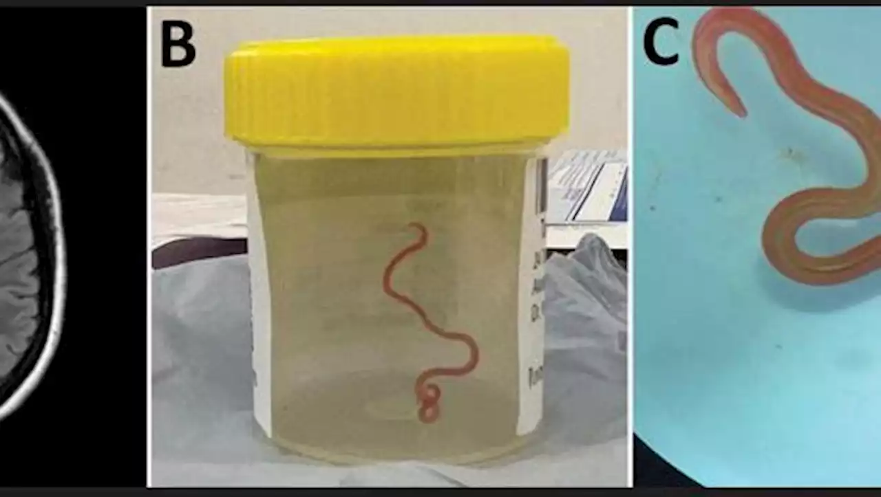 Australien: Ärztin entfernt lebenden 8-Zentimeter-Wurm aus menschlichem Gehirn