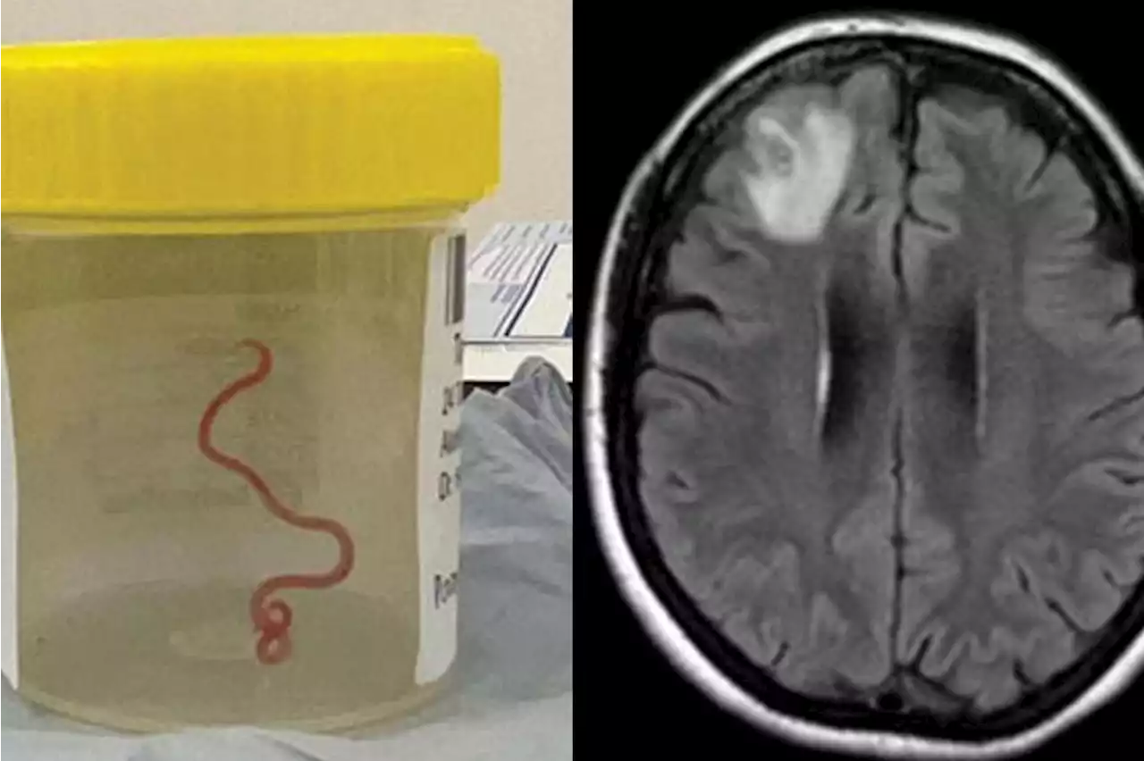 ‘Alive and wriggling’: Live worm found in woman’s brain in Australia