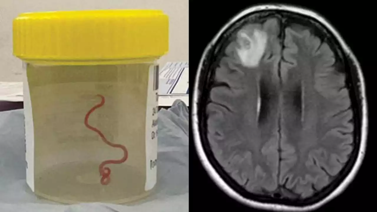 Australian doctors find live parasitic worm in woman's brain