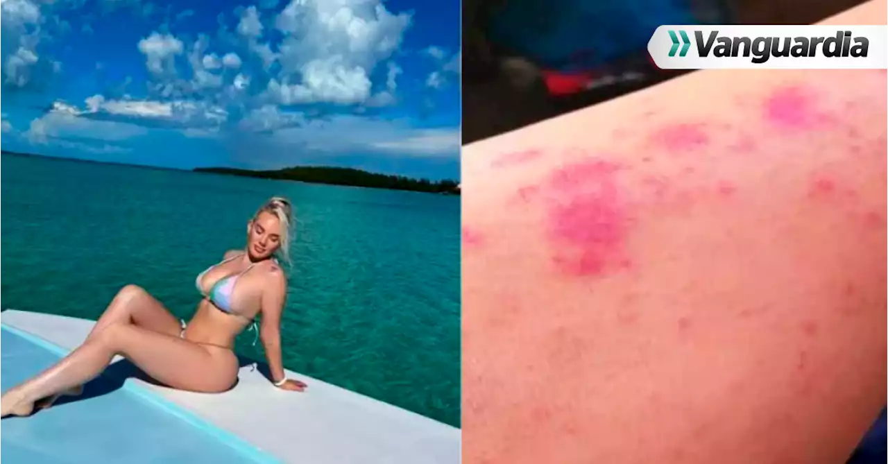 Amputan pierna a modelo luego de infectarse de bacteria ‘come carne’, en Bahamas