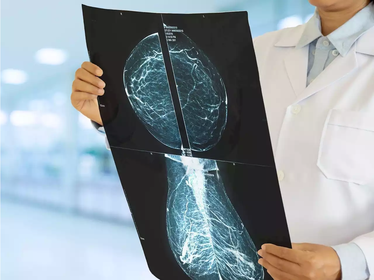 AI can detect breast cancer in mammograms as well as radiologists: study