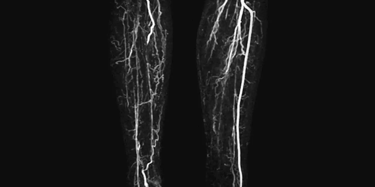 PAD Procedure Overuse: Field in Peril or 'A Few Bad Apples'?