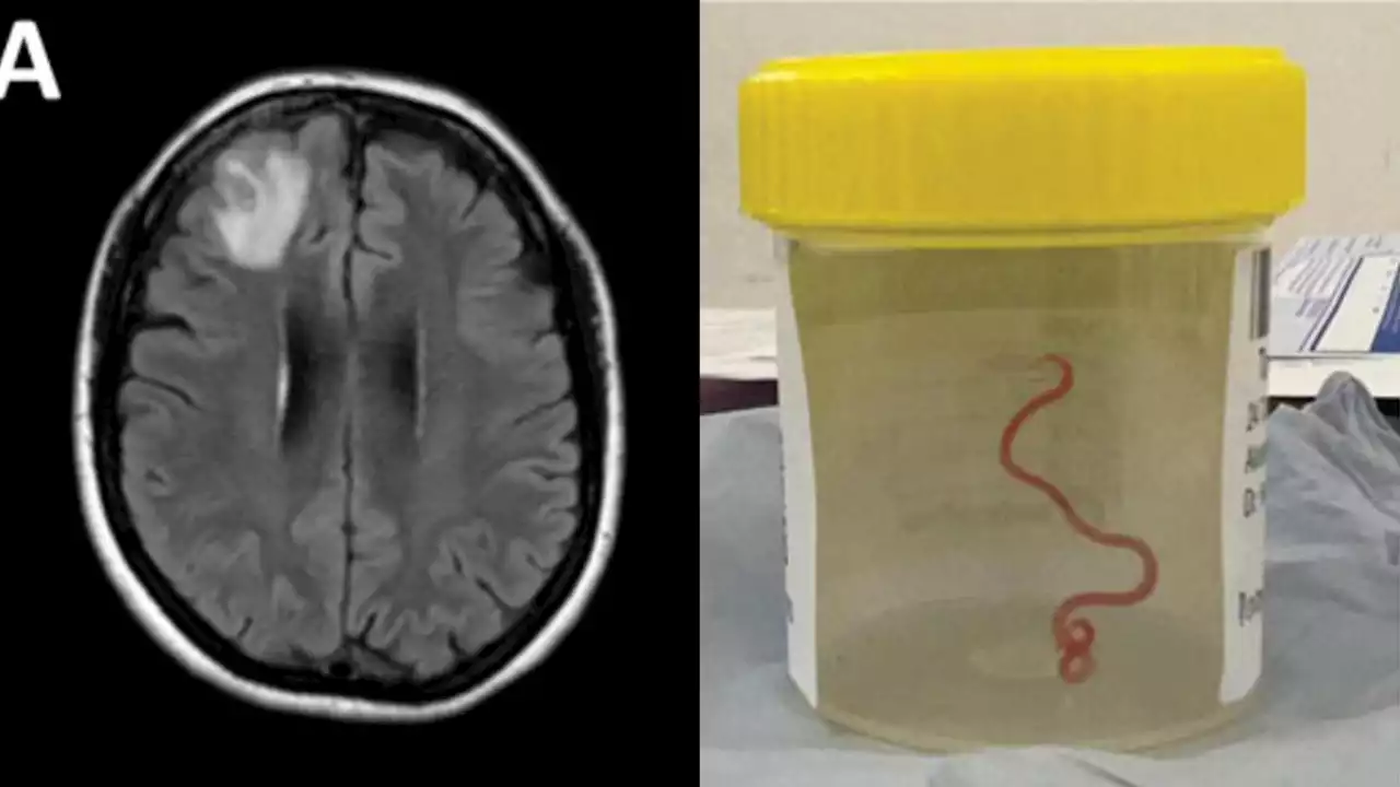 Extraen del cerebro de una mujer una lombriz intestinal viva de 8 centímetros