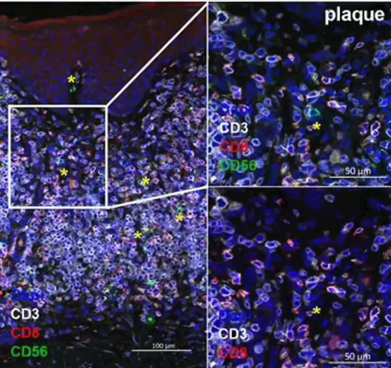 Impaired natural killer cells in cutaneous lymphoma: Possible new targets for future therapies