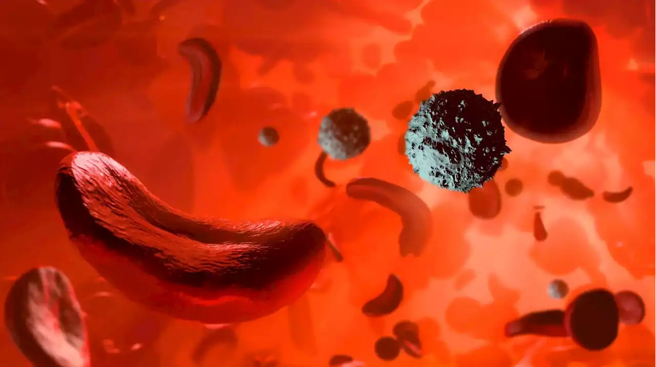 Startling New Research: Sickle Cell Disease Is 11 Times More Deadly Than Previously Thought