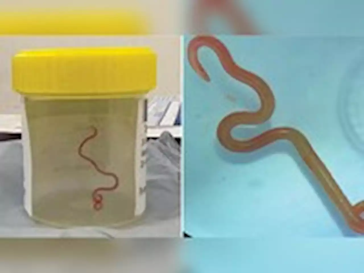 How a medical mystery led to a wriggling, parasitic worm in a woman’s brain