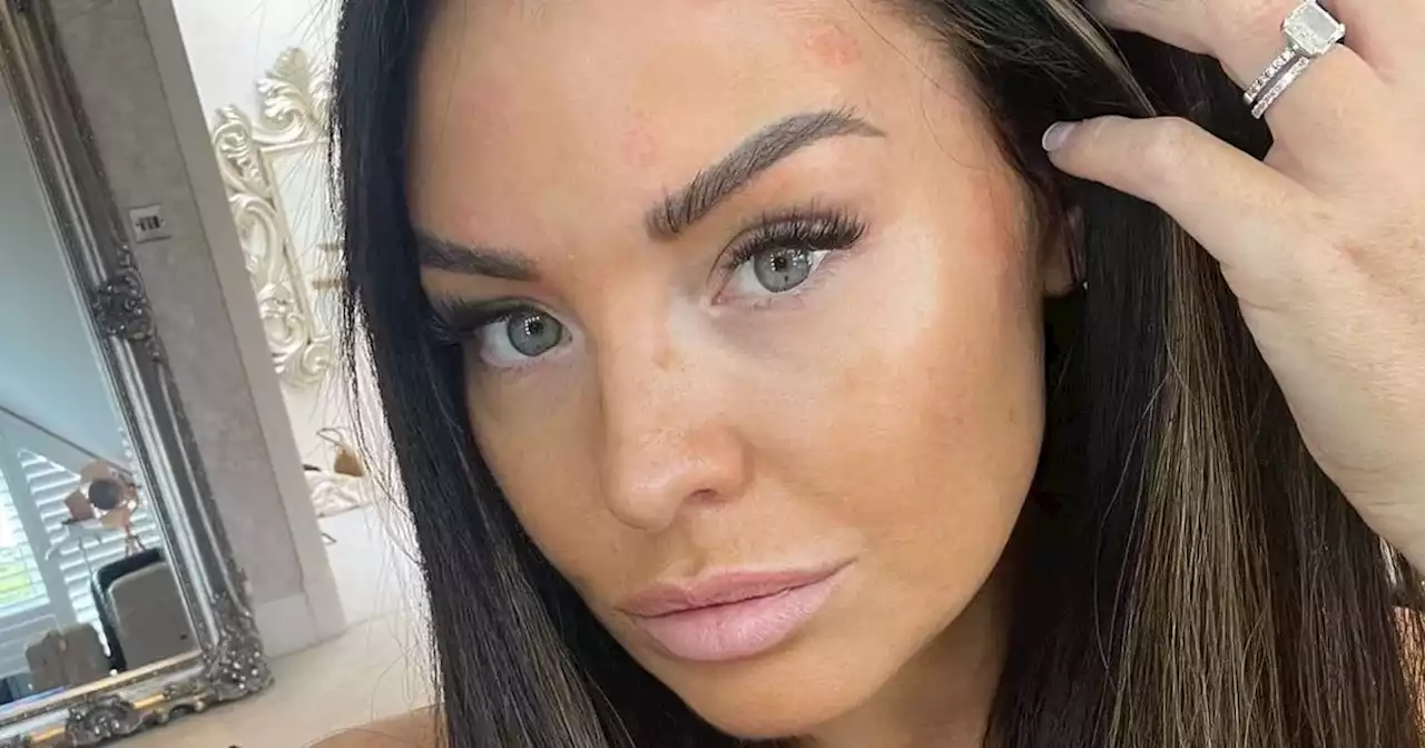 'I'm in so much pain' Jess Wright shares painful psoriasis battle