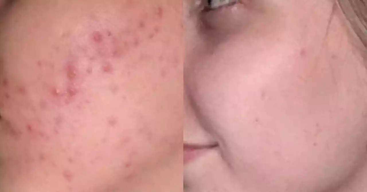 Shoppers rave over £20 acne treatment that 'works in 24 hours'