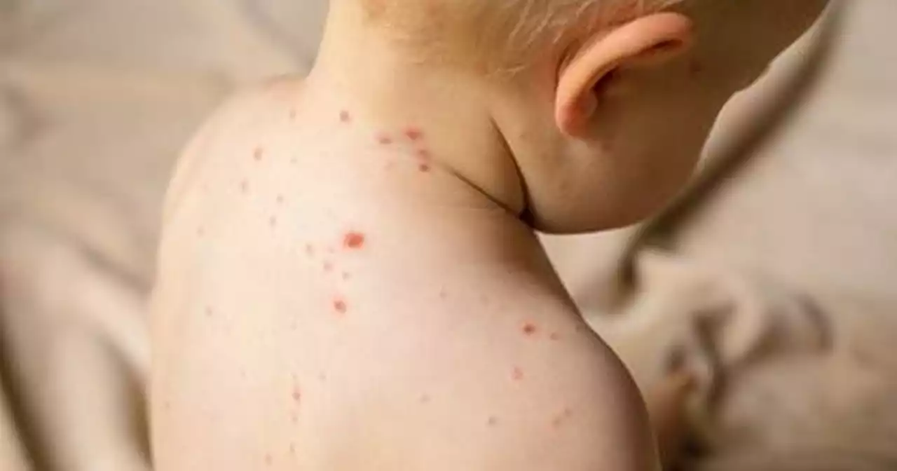 Measles warning as MMR vaccination rates fall again - see stats in your area