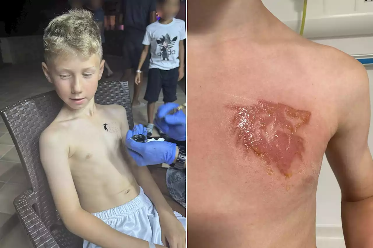 My son, 9, is scarred for life after holiday henna tattoo caused chemical burns