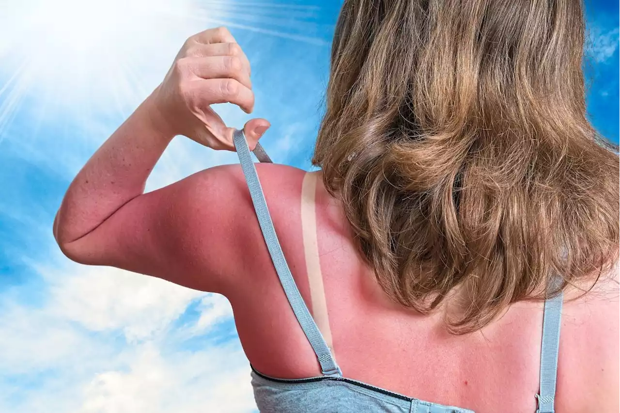 Here's how to avoid that sunburn