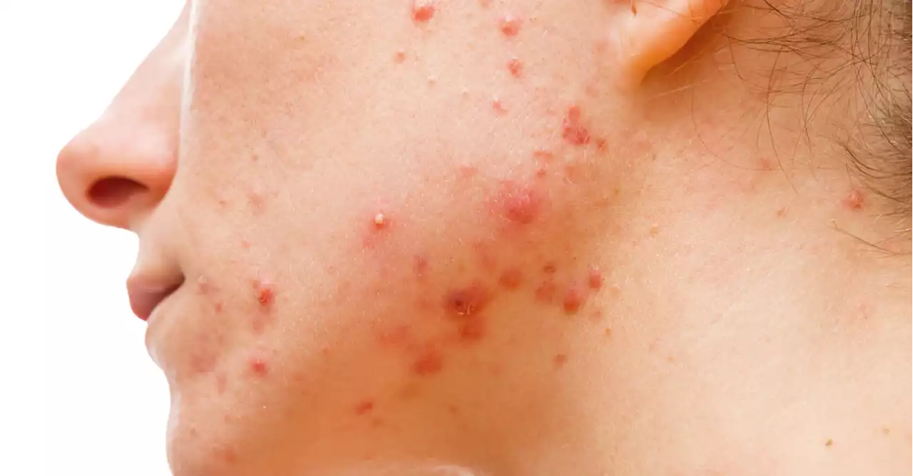 Acne: Primary Care Treatment Pathway