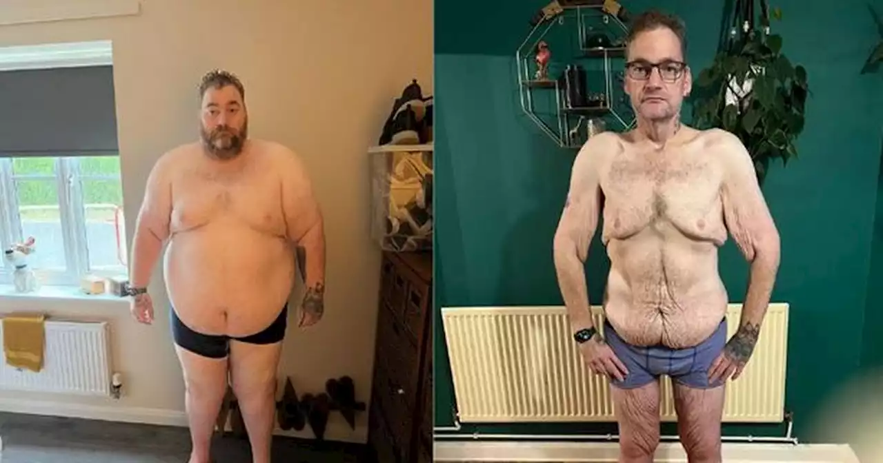 Man who shed 20 stone can't get surgery to remove loose skin on NHS