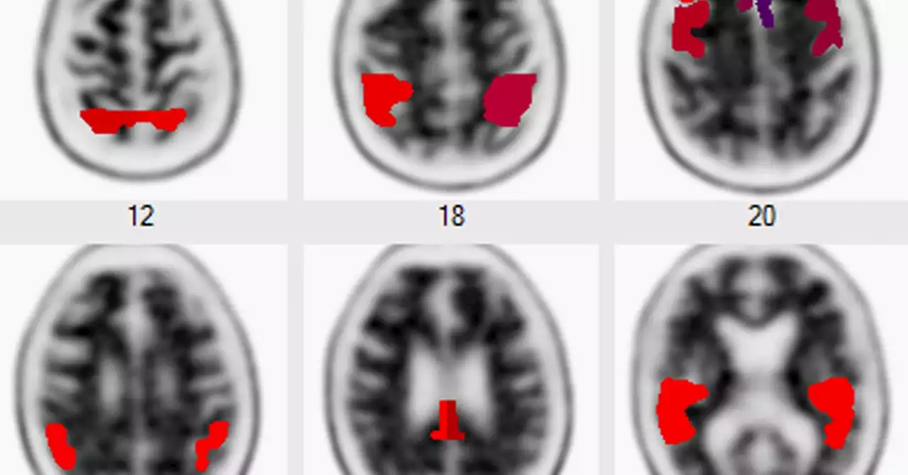 A New Blood Test May Predict Your Alzheimer’s Risk. Should You Take It?