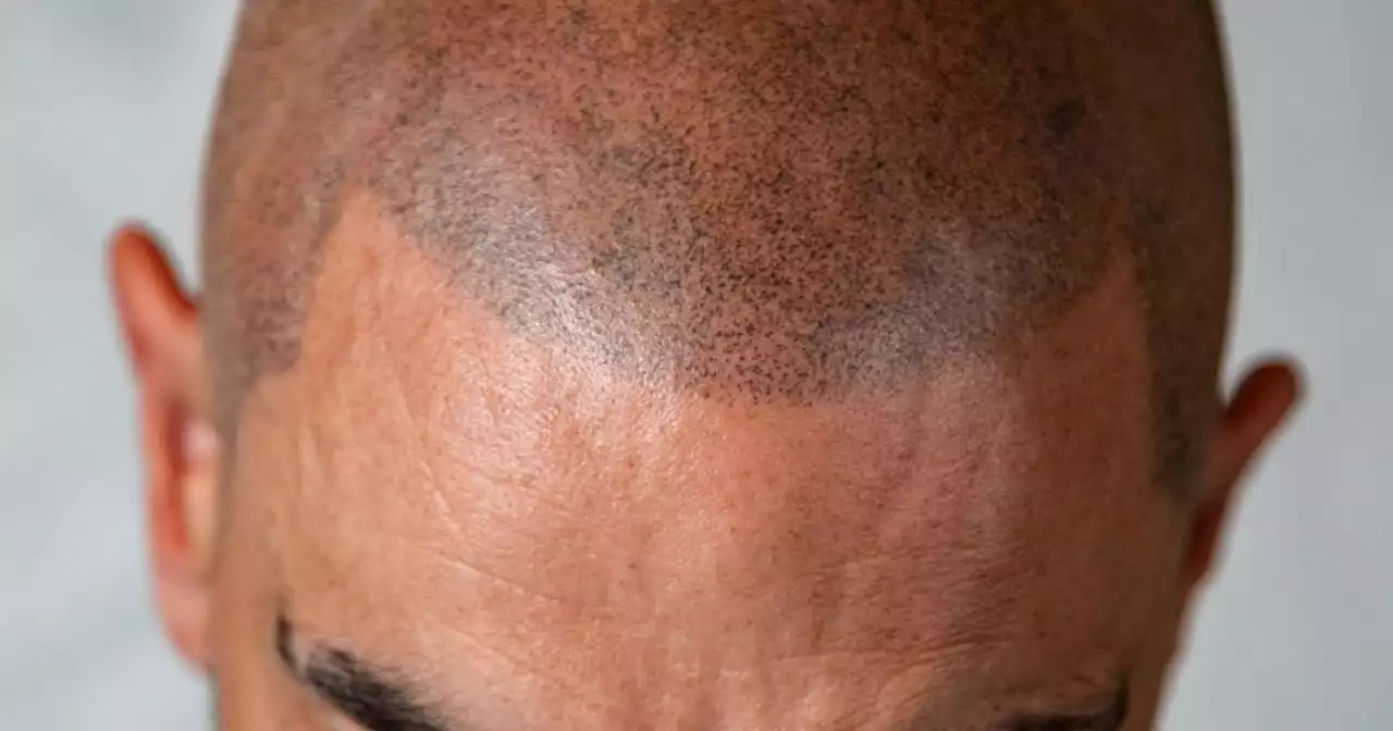 'I spent £2k on getting head tattooed after hearing hair transplant horrors'