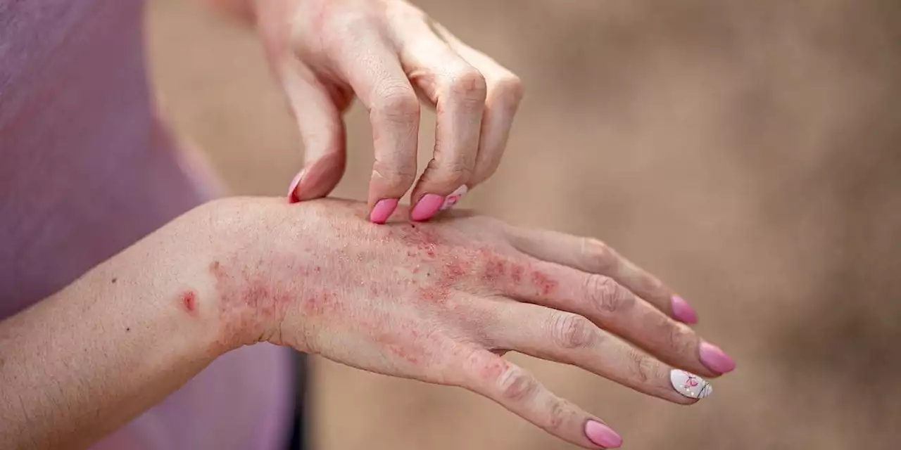 Dermatologie: Beeinflusst die Hautflora die Bildung von Ekzemen?